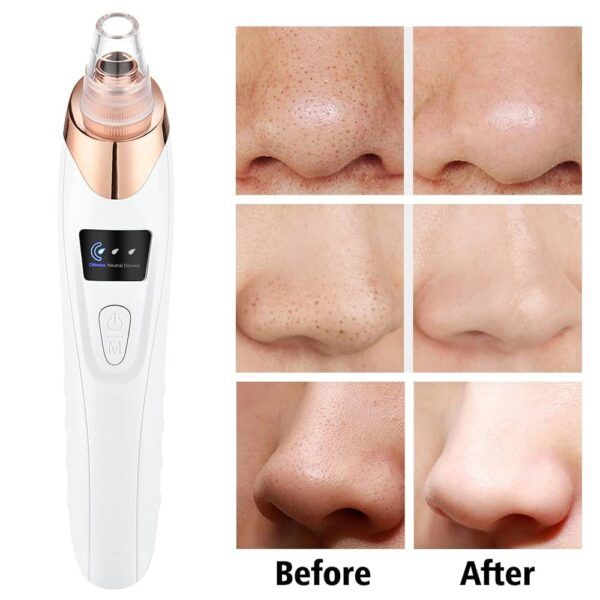 5 in 1 Blackhead remover | Derma Suction  | Rechargeable